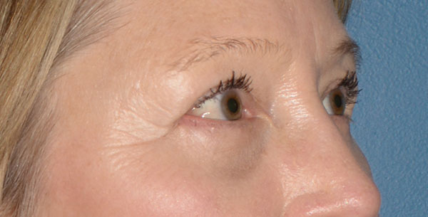 Eyelid Lift