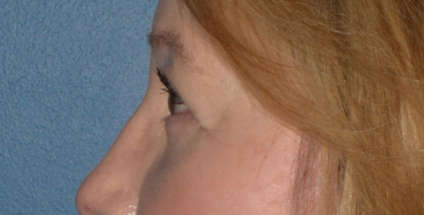 Eyelid Lift