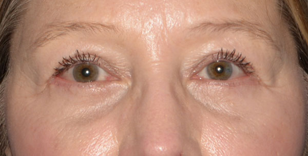 Eyelid Lift