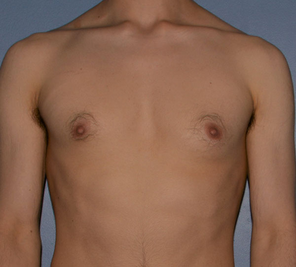 Male Breast Reduction Bellevue