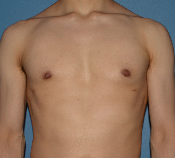 Male Breast Reduction Results Bellevue