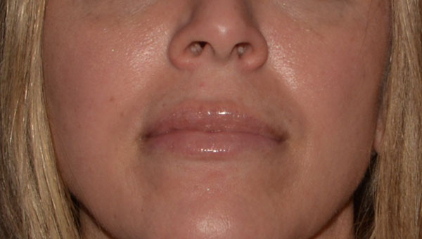 Lip Implants