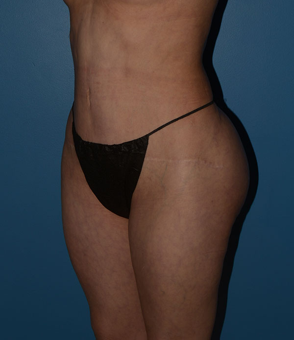 Liposuction