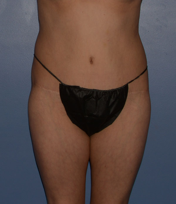 Liposuction