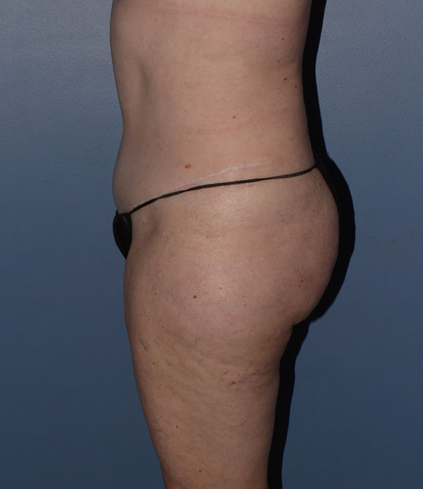 Liposuction