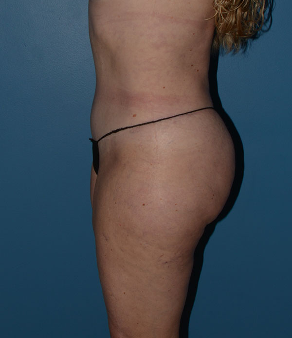 Liposuction