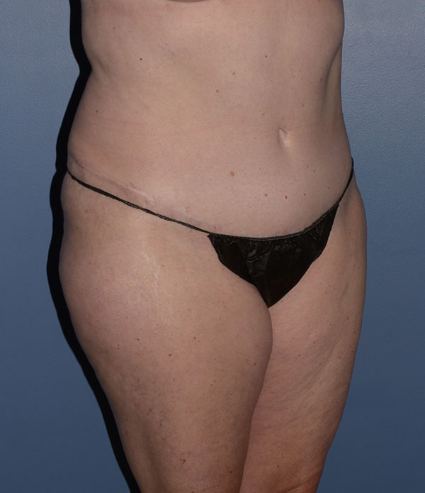 Liposuction