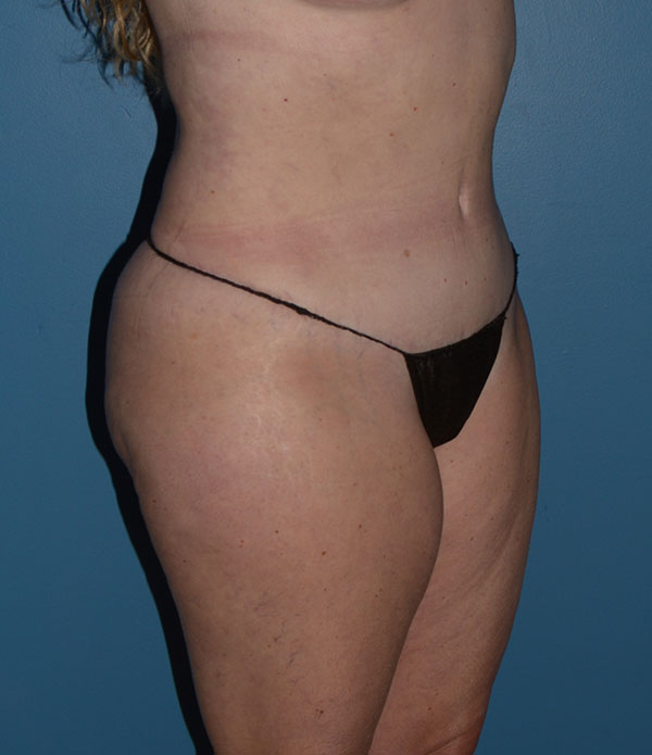 Liposuction