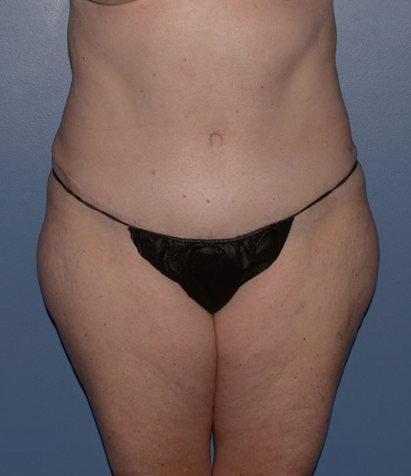 Liposuction