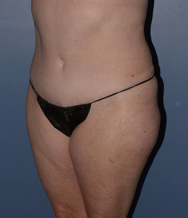 Liposuction