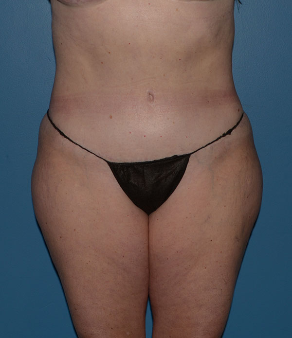 Liposuction