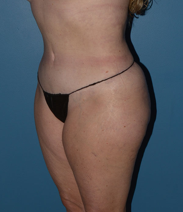 Liposuction