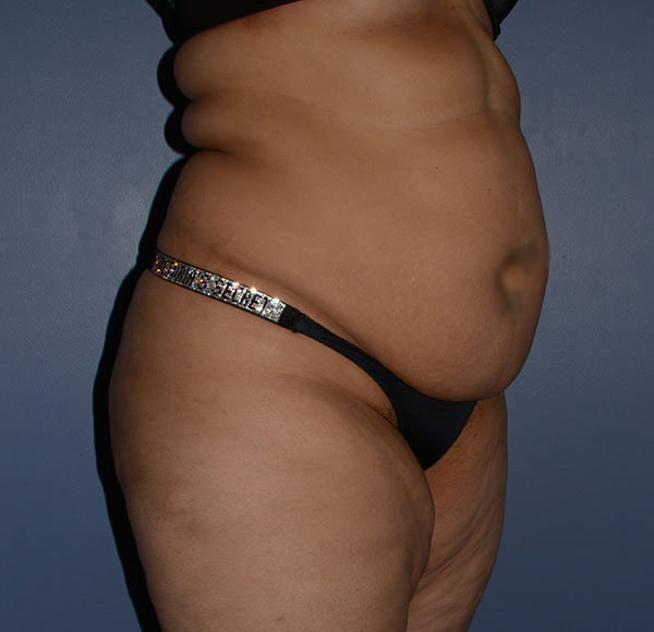 Tummy Tuck