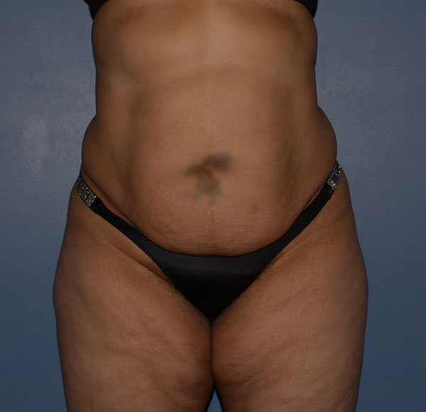 Tummy Tuck
