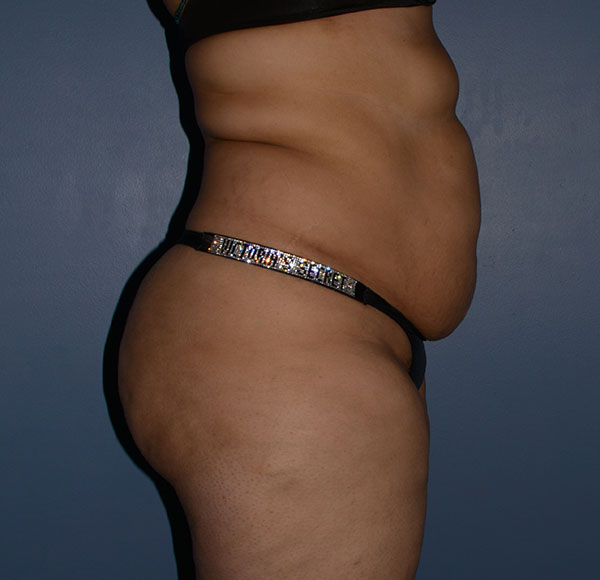 Tummy Tuck