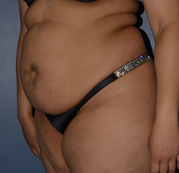 Tummy Tuck