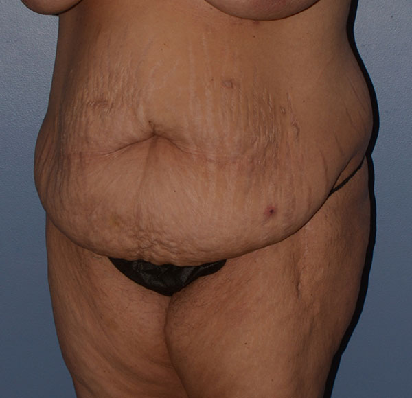 Tummy Tuck