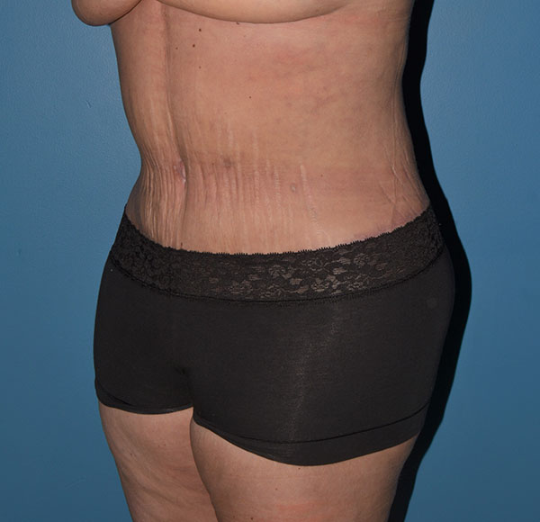 Tummy Tuck