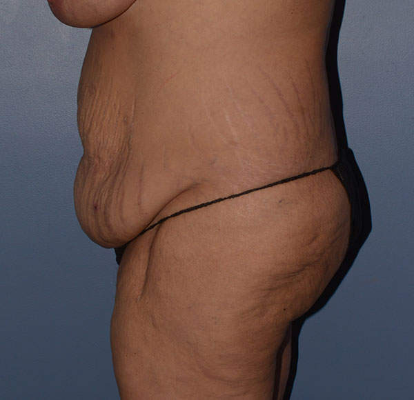 Tummy Tuck