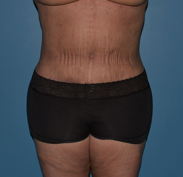 Tummy Tuck