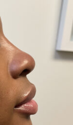 Non-Surgical Rhinoplasty