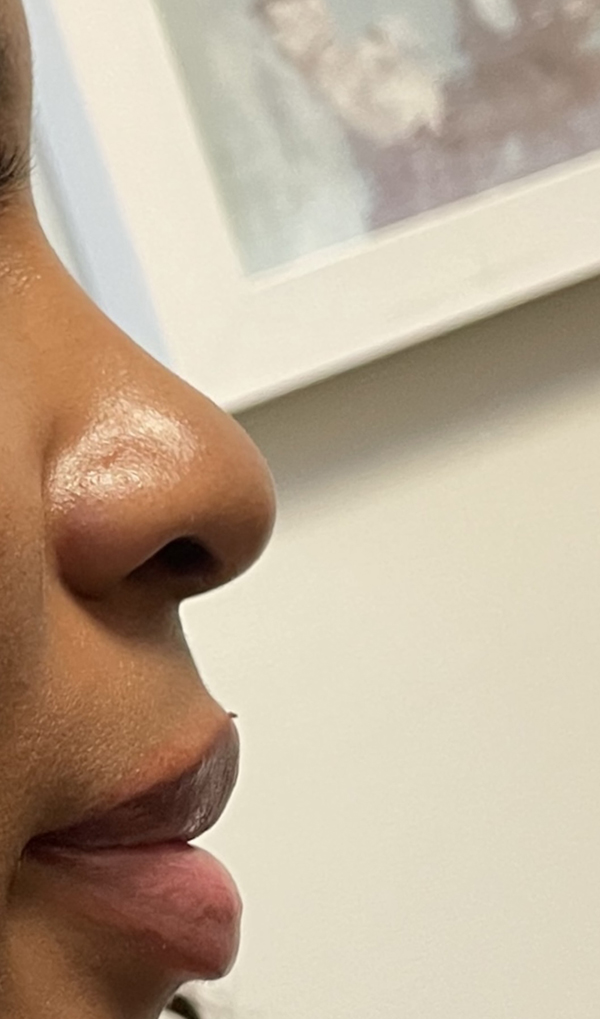 Non-Surgical Rhinoplasty