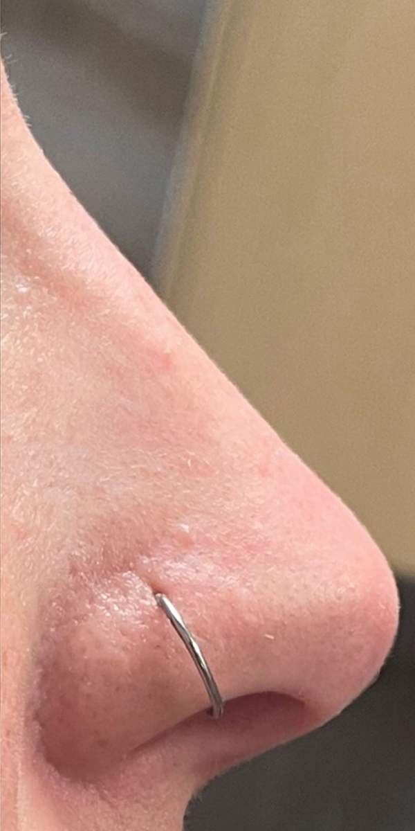 Non-Surgical Rhinoplasty