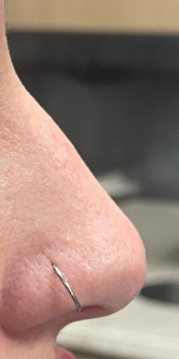 Non-Surgical Rhinoplasty