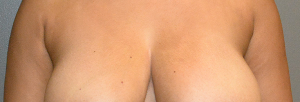 Axillary Accessory Breast