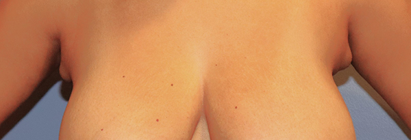 Axillary Accessory Breast