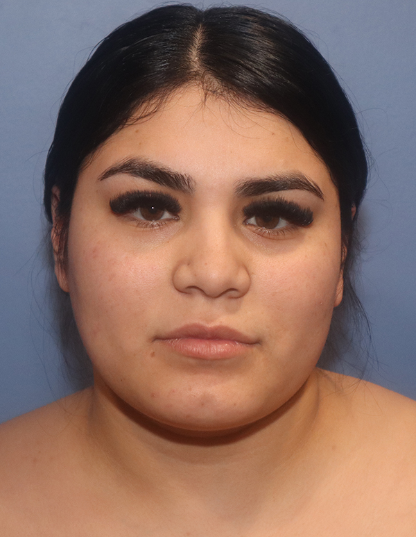 Chin and Jawline Liposuction