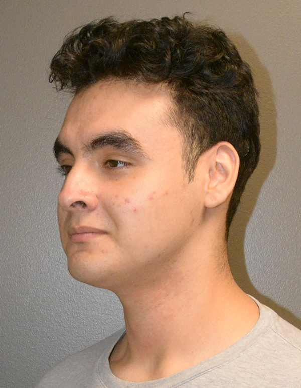 Chin and Jawline Liposuction