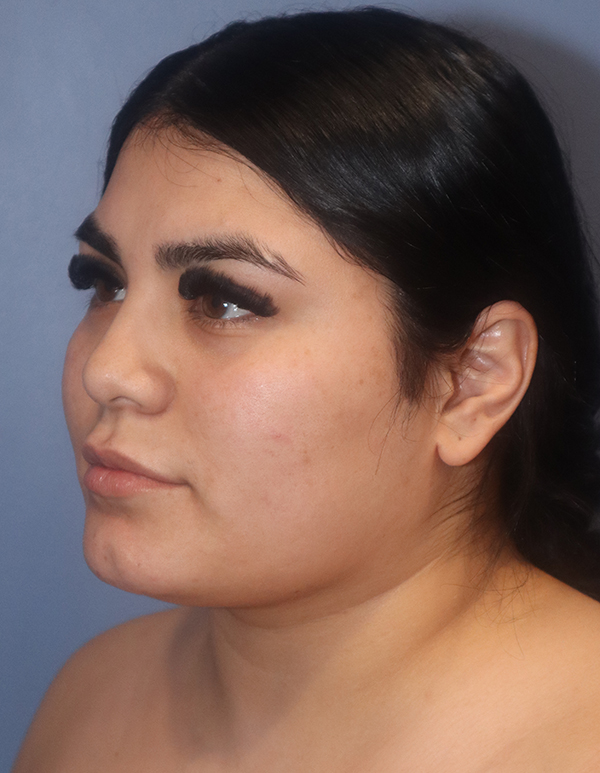 Chin and Jawline Liposuction