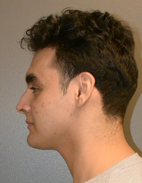 Chin and Jawline Liposuction