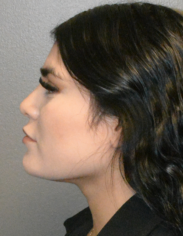 Chin and Jawline Liposuction