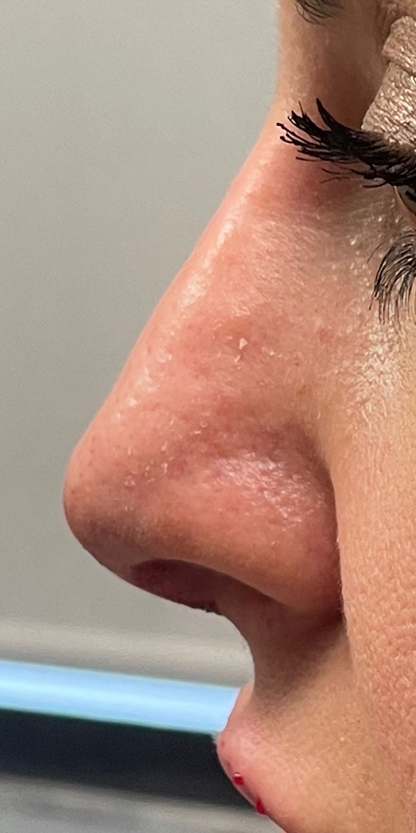 Non-Surgical Rhinoplasty