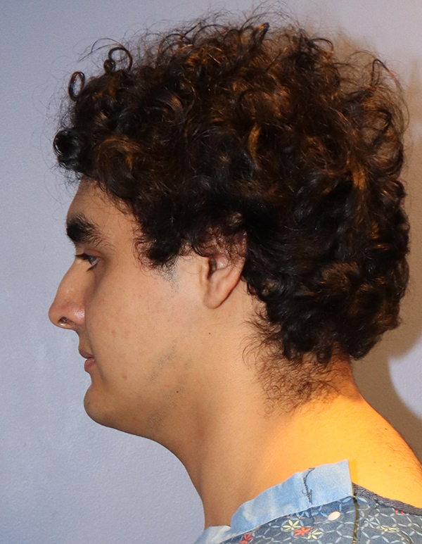 Chin and Jawline Liposuction