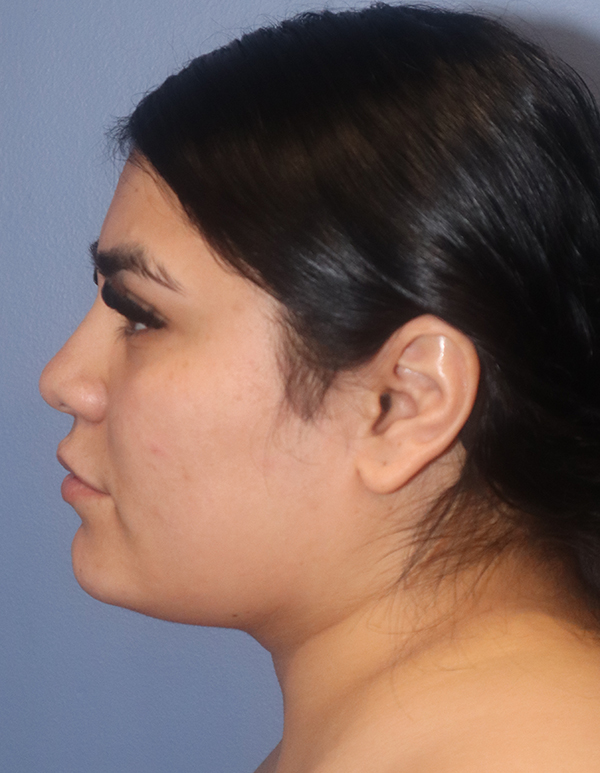 Chin and Jawline Liposuction