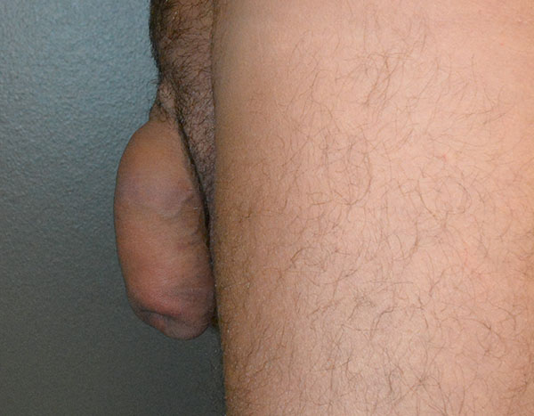 Penile Fat Transfer
