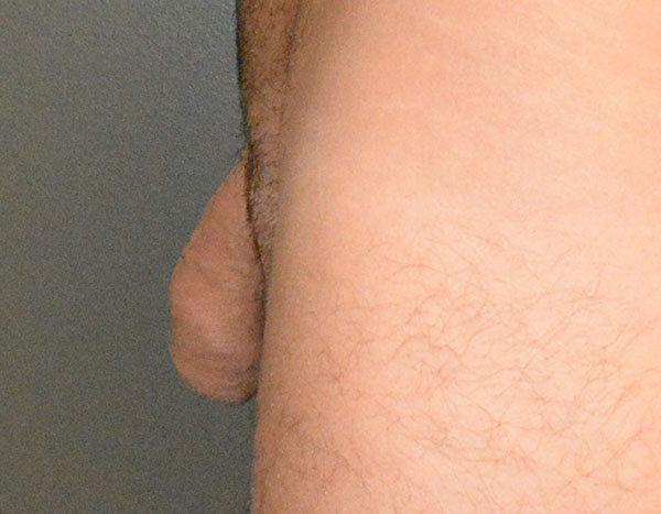 Penile Fat Transfer