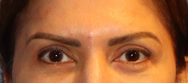 Brow Lift