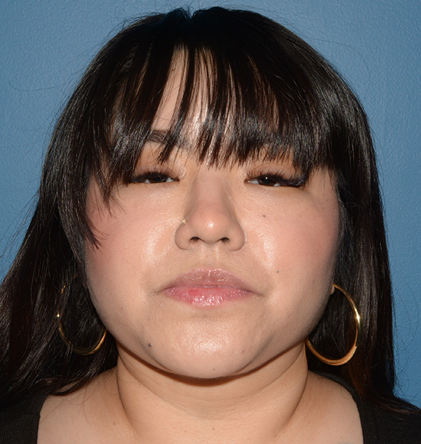 Buccal Fat Removal