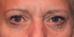 Eyelid Lift