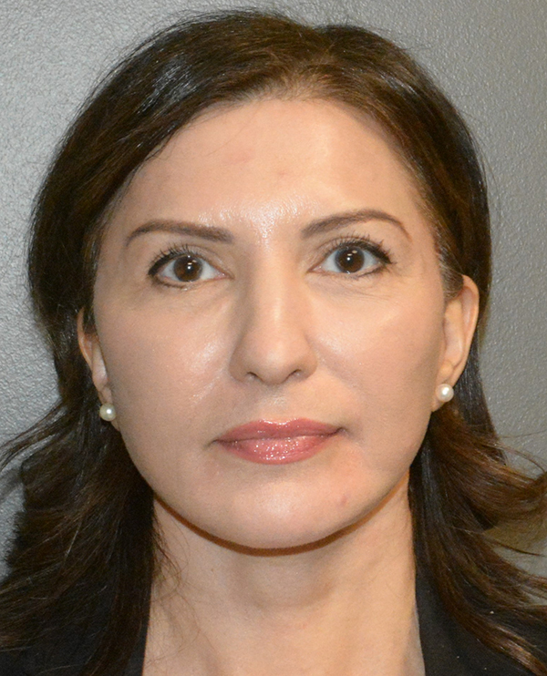 Facelift