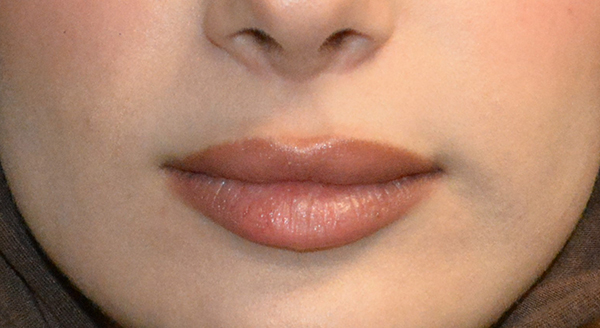 Lip Lift