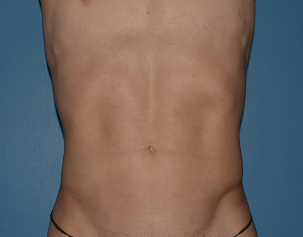 Liposuction