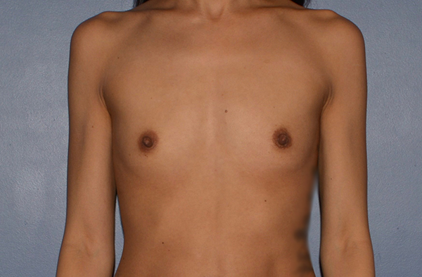 Breast Augmentation Implants