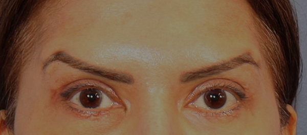 Brow Lift