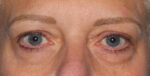 Eyelid Lift