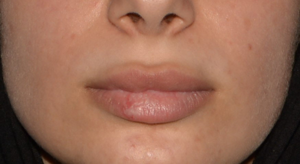 Lip Lift